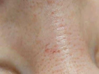 Ultrazvukový peeling před ošetřením